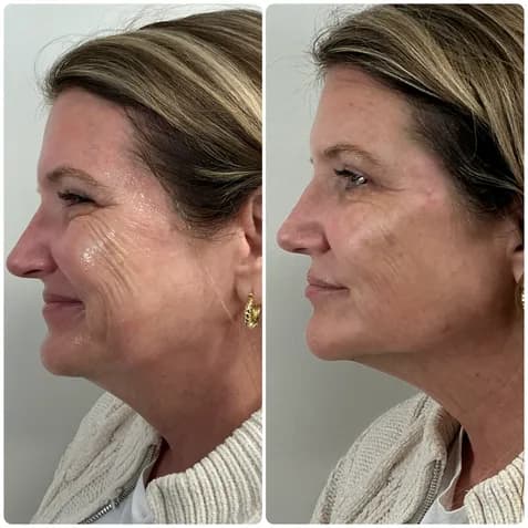 Dermal filler before and after — cheeks, jawline, and chin