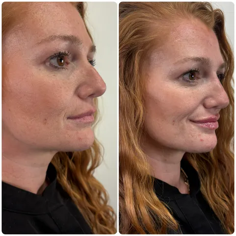 Dermal filler before and after — chin, lips, and nose bridge enhancement